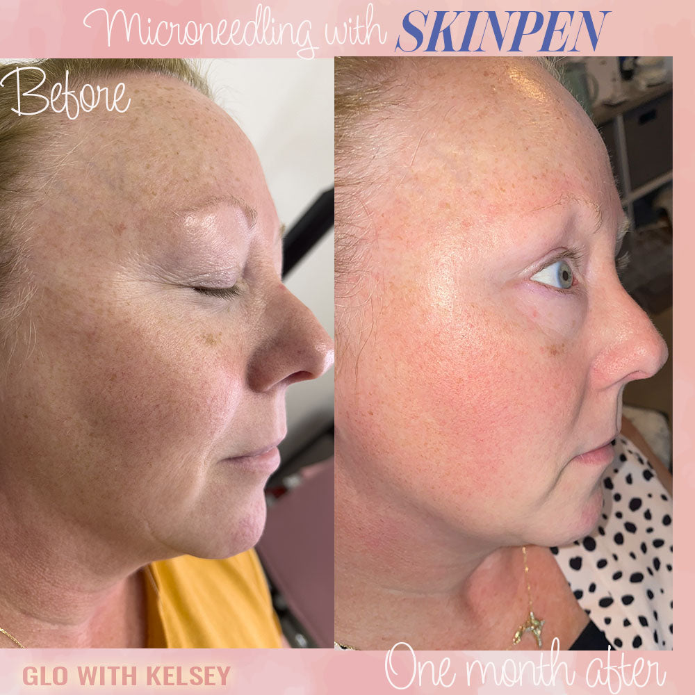 SkinPen Treatment Revitalize Renew Your Skin – GLO with Kelsey